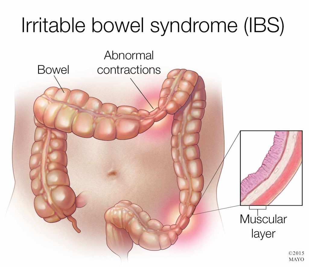 What is irritable bowel syndrome?