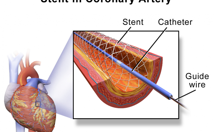 STENT BANDHI