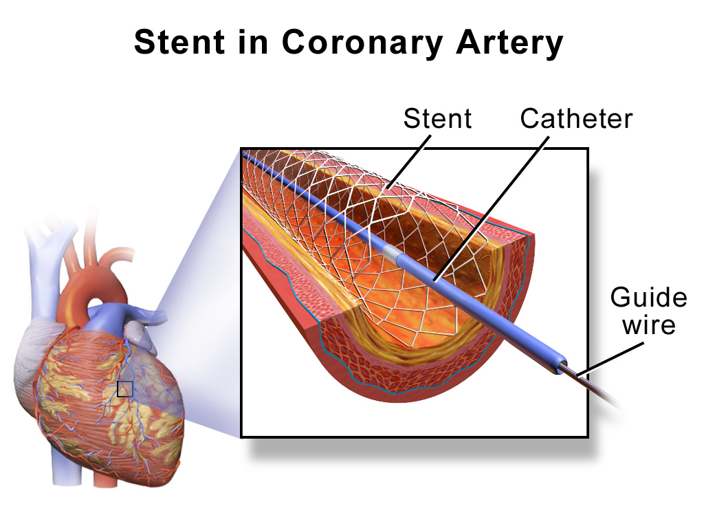 STENT BANDHI