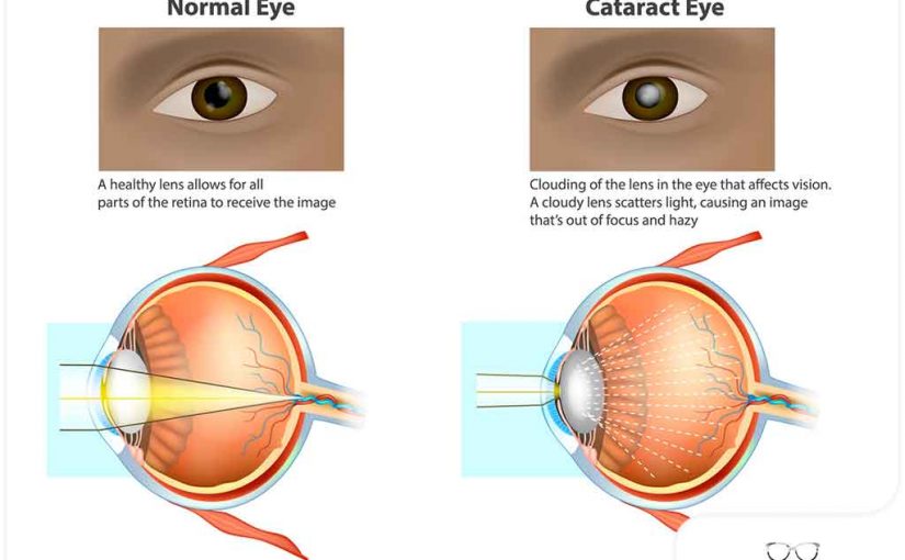 WHY DO WE GET CATARACTS?