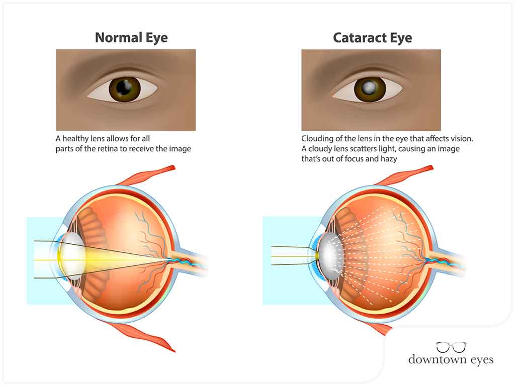 WHY DO WE GET  CATARACTS?