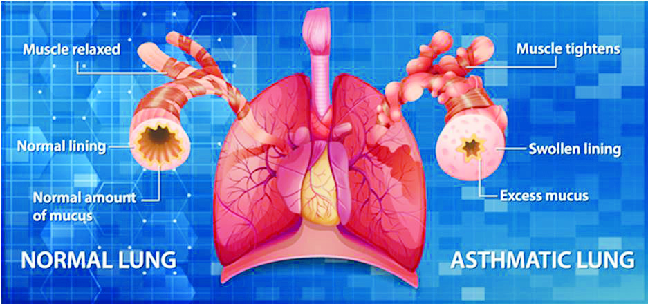 CLOSING GAPS IN ASTHMA CARE!