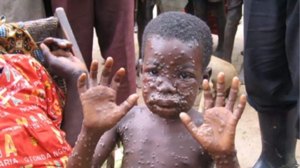 SPECIAL WARD FOR MONKEYPOX IN MUMBAI HOSPITAL!