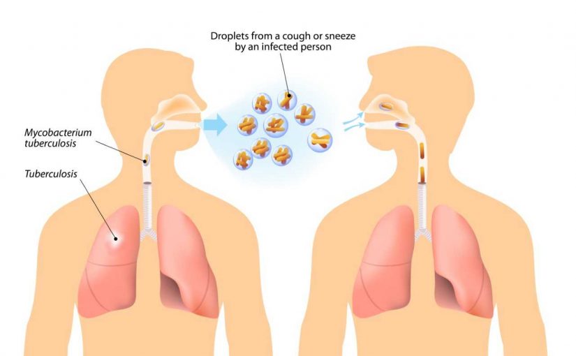 STIGMA ATTACHED TO TUBERCULOSIS CONTINUES!