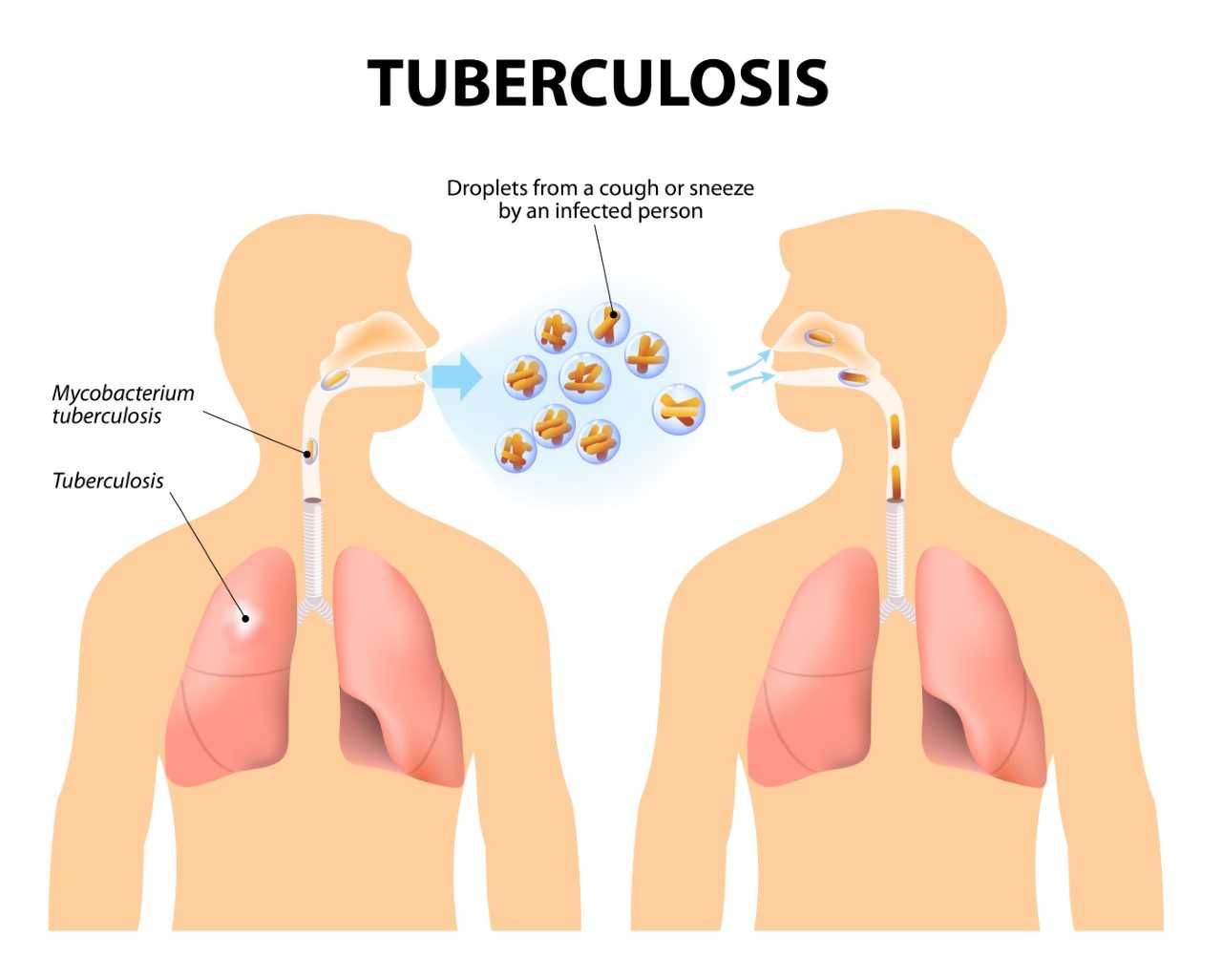 STIGMA  ATTACHED  TO TUBERCULOSIS CONTINUES!