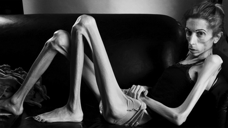 EVER HEARD OF ANOREXIA?