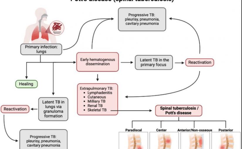 IS THERE SOMETHING CALLED SPINAL TB?