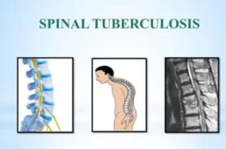 TB TREATMENT RACKET?