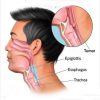 BEWARE CANCER OF THE THROAT!