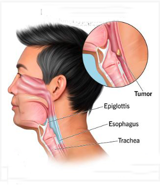 BEWARE CANCER OF THE THROAT!